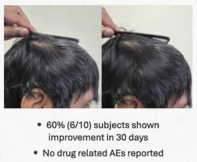 Can you Reverse Grey Hair? New Updates.