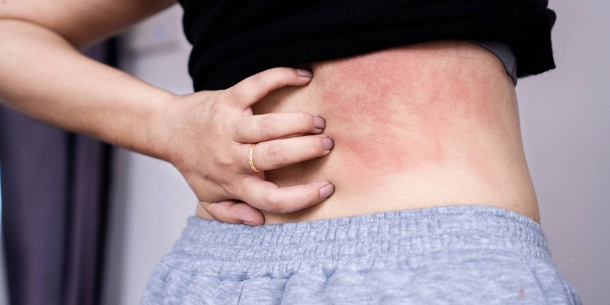 Living with Chronic Spontaneous Urticaria