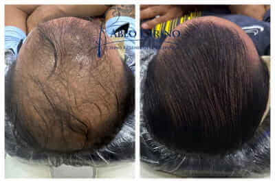 The Cirino Regenerative Technique | Hair Loss Cure 2020
