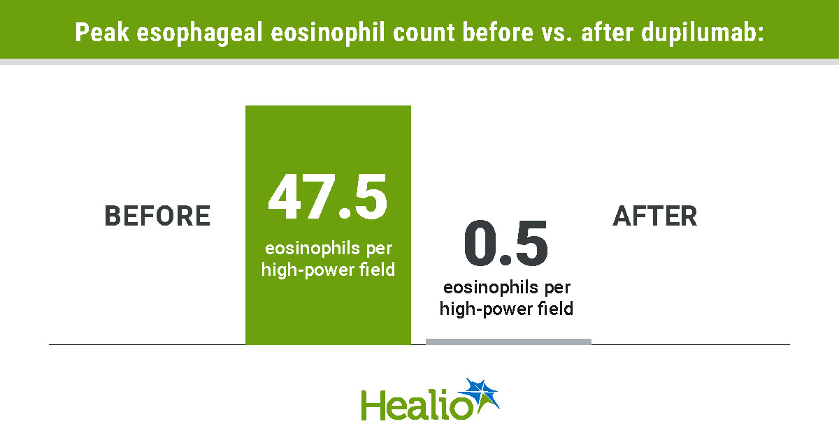 Dupilumab shows benefits in EoE not meeting approval thresholds