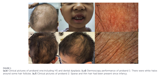Two New LSS Gene Variants Expand Our Understanding of Congenital Hypotrichosis — Donovan Hair Clinic