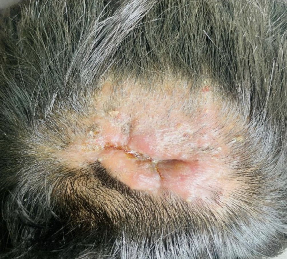 When Kerion Masquerades as a Scalp Abscess: A Lesson Every Clinician Should Know — Donovan Hair Clinic