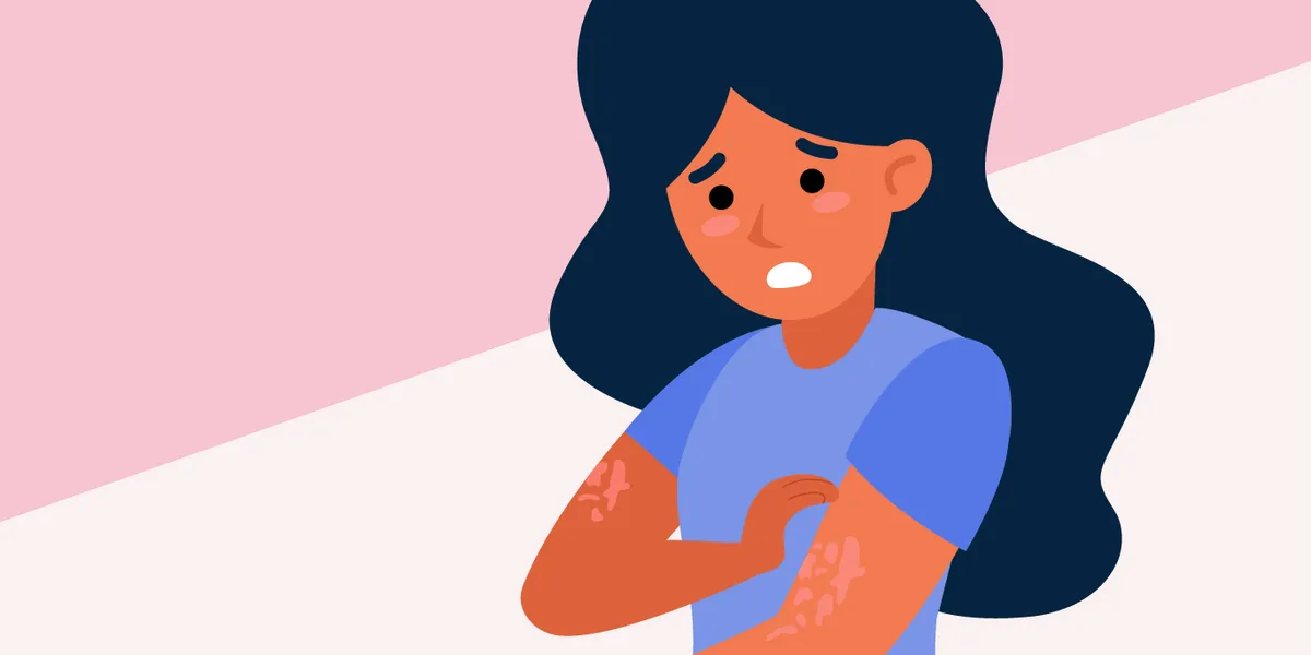 Información comprobada sobre la urticaria crónica espontánea