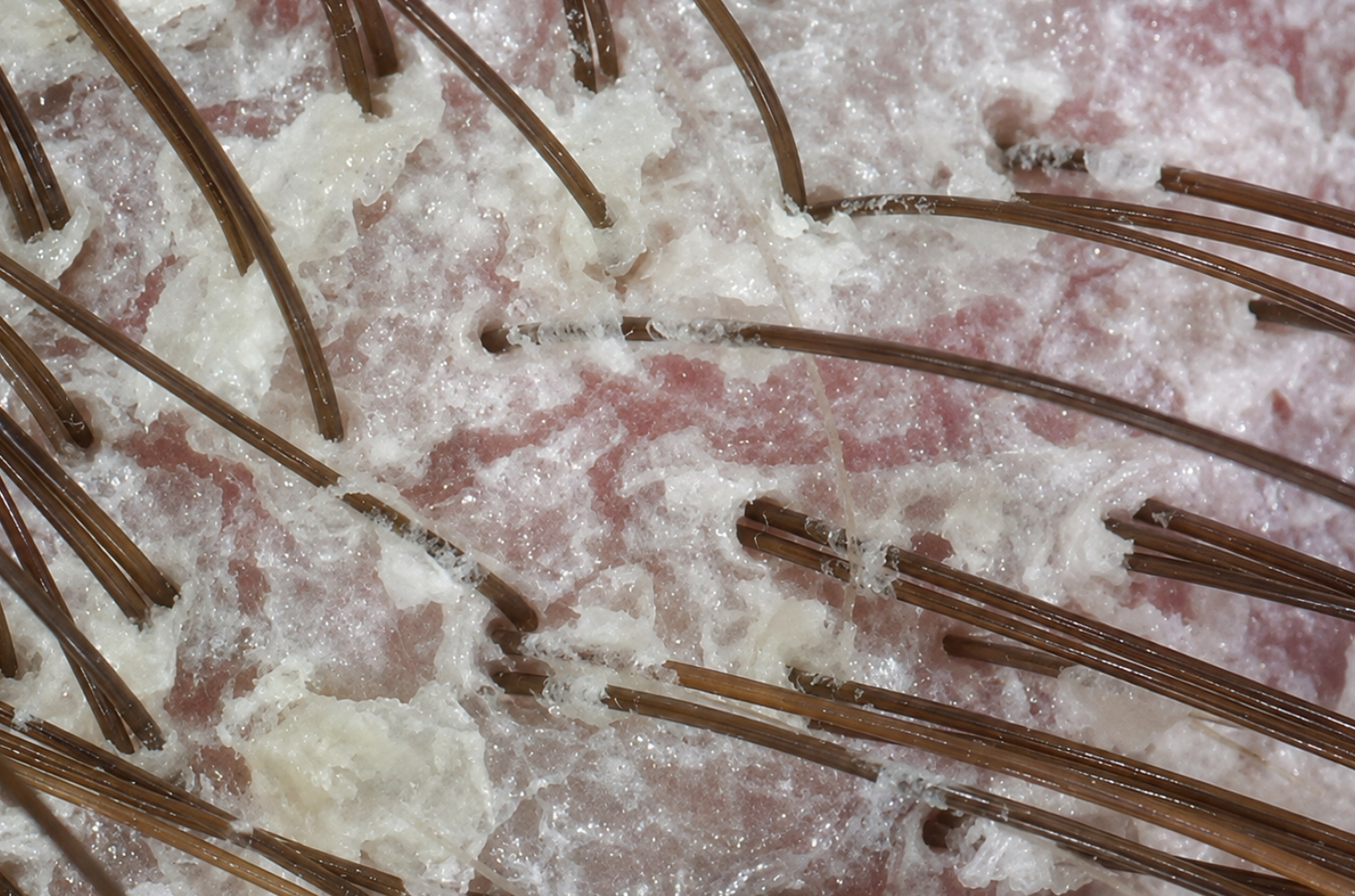 Scalp Psoriasis: Causes, Treatments, and Hair Loss Explained