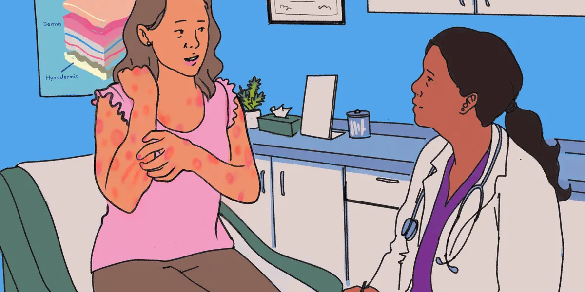 Holly has chronic spontaneous urticaria