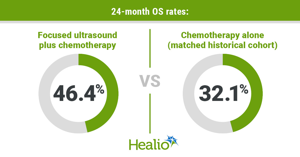 Focused ultrasound may improve pancreatic cancer outcomes