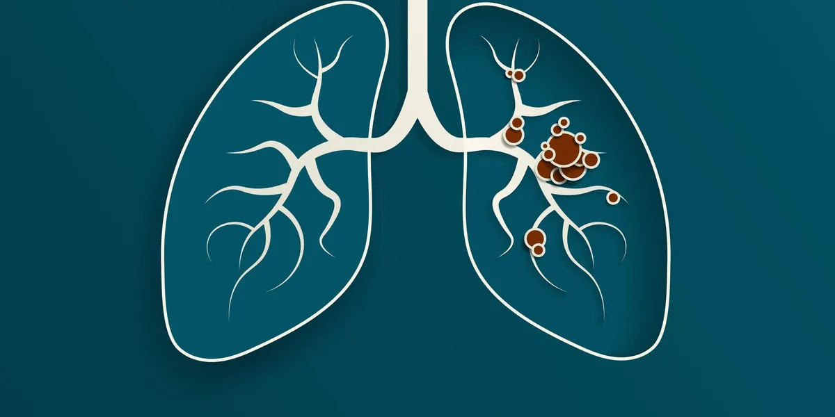 How Do Lung Cancer Biomarkers Help Guide Treatment?