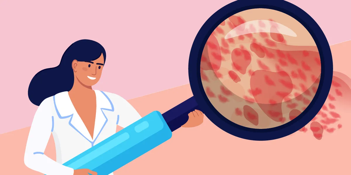 ¿Qué es la urticaria crónica espontánea?