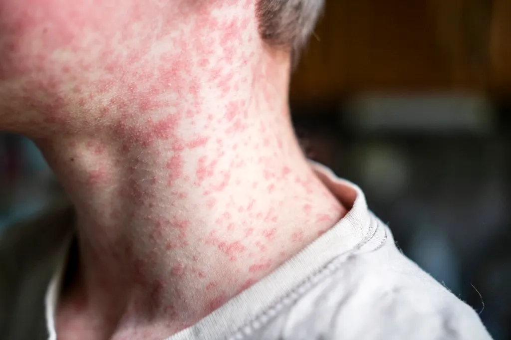 Why the CDC is Excluding Pennsylvania Measles Deaths From Its Tally